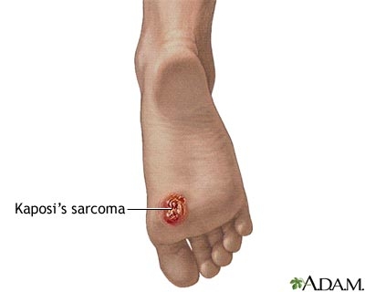 Kaposi's sarcoma affected area